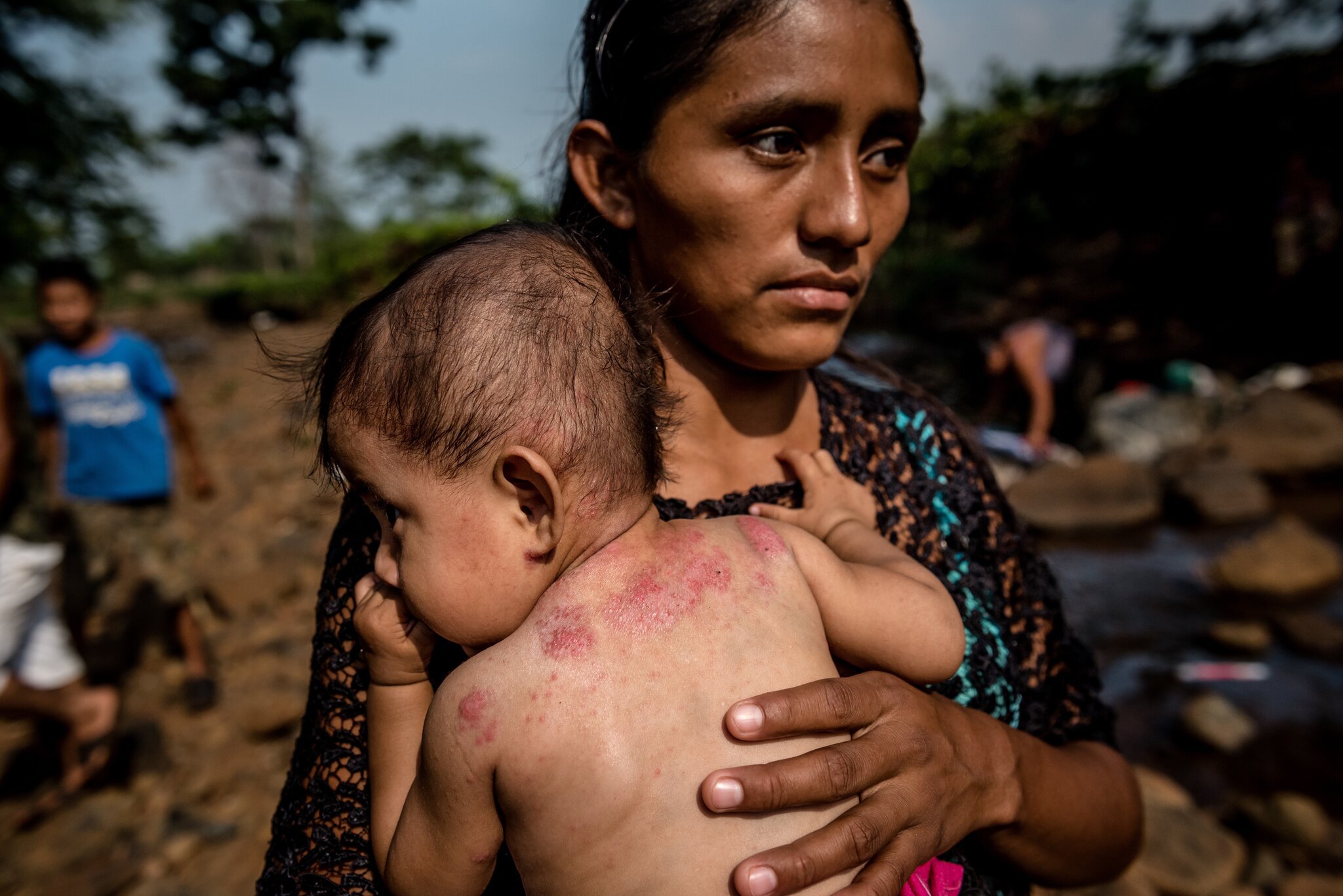 Індіанка (indigena) з донькою, у якої шкірна інфекція — згідно з діагнозом, від забрудненої води: Гватемала, Nuevo Paraíso ("Новий рай")