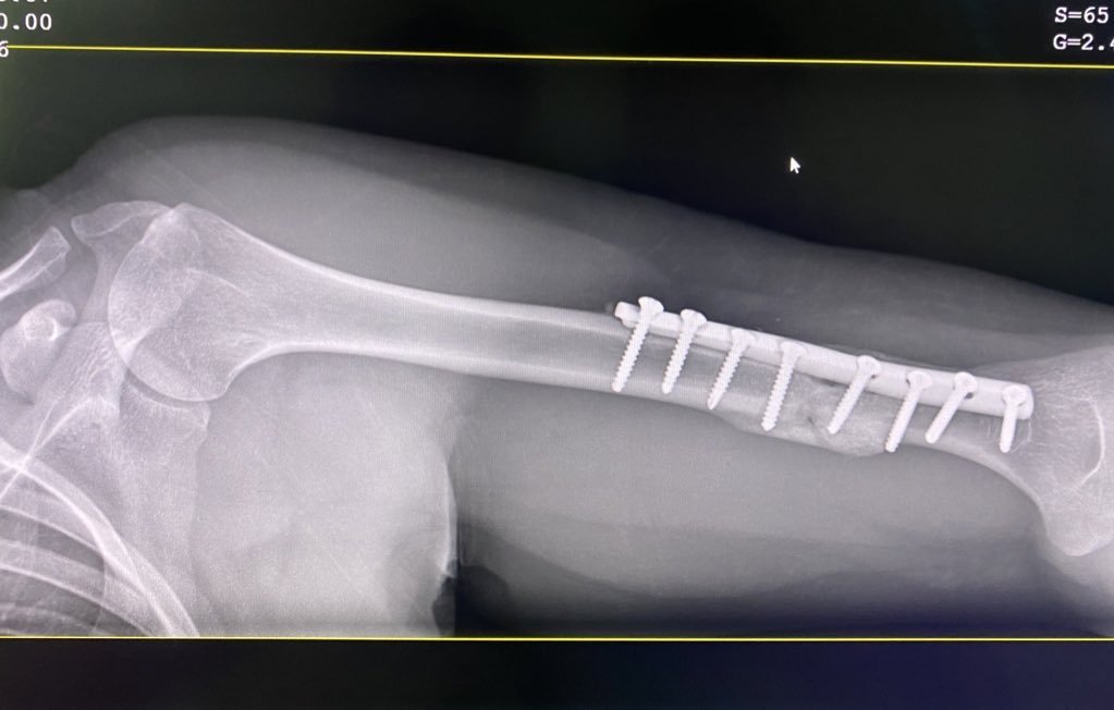 Рентгенівський знімок з титановою пластиною всередині руки