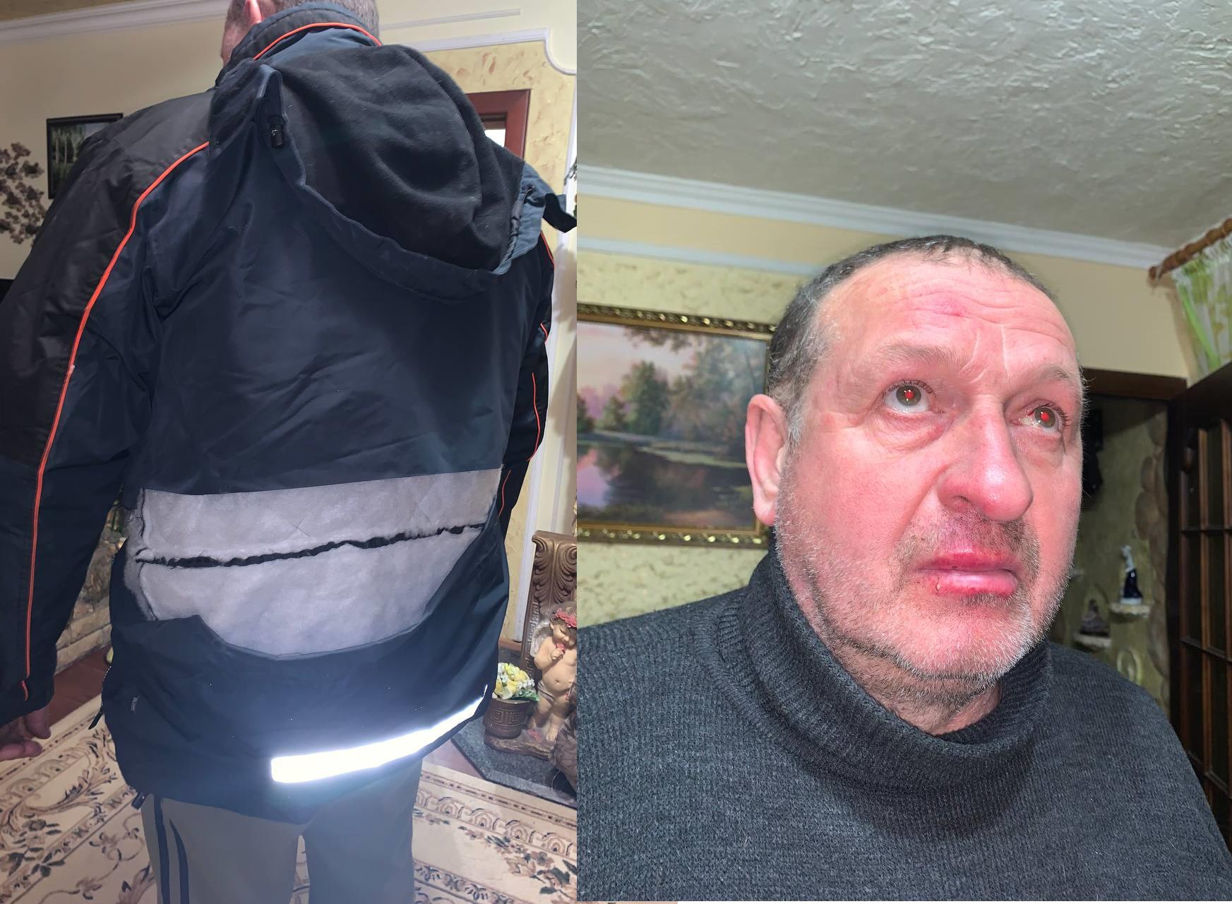 Валерій Ліневич після побоїв поліцейськими 27 січня 2026 року. Наступного дня в місцевій лікарні родині натякнули, що знімати побої їм заборонили «згори». Жорстокість поліції родина пояснює бажанням залякати і змусити мовчати. Фото авторки